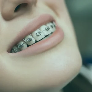 Patients seeking dental braces in Istanbul or elsewhere should understand the comprehensive nature of orthodontic care at Esnan.