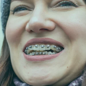 Adults seeking dental braces in Turkey, including Istanbul, are increasingly common. With orthodontic technology, they can achieve desired results efficiently.