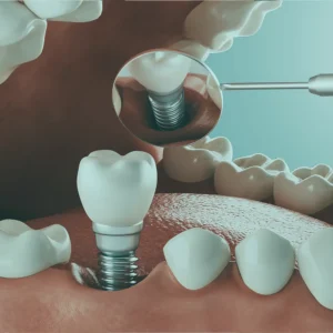 When it comes to treatment of dental implant in Turkey, having a qualified and experienced oral surgeon is a key factor in overall success.