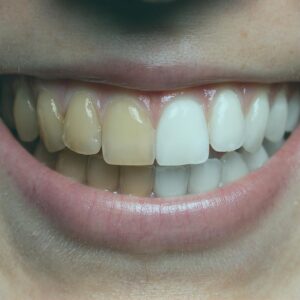 Dental veneers in Turkey have gained widespread popularity, attracting patients from near and far to experience the benefits of quality dental care.