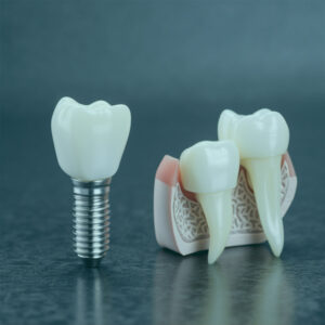 Discover top-quality dental implants in Turkey. Explore expert care, advanced techniques, and affordable options for restoring your smile with confidence.