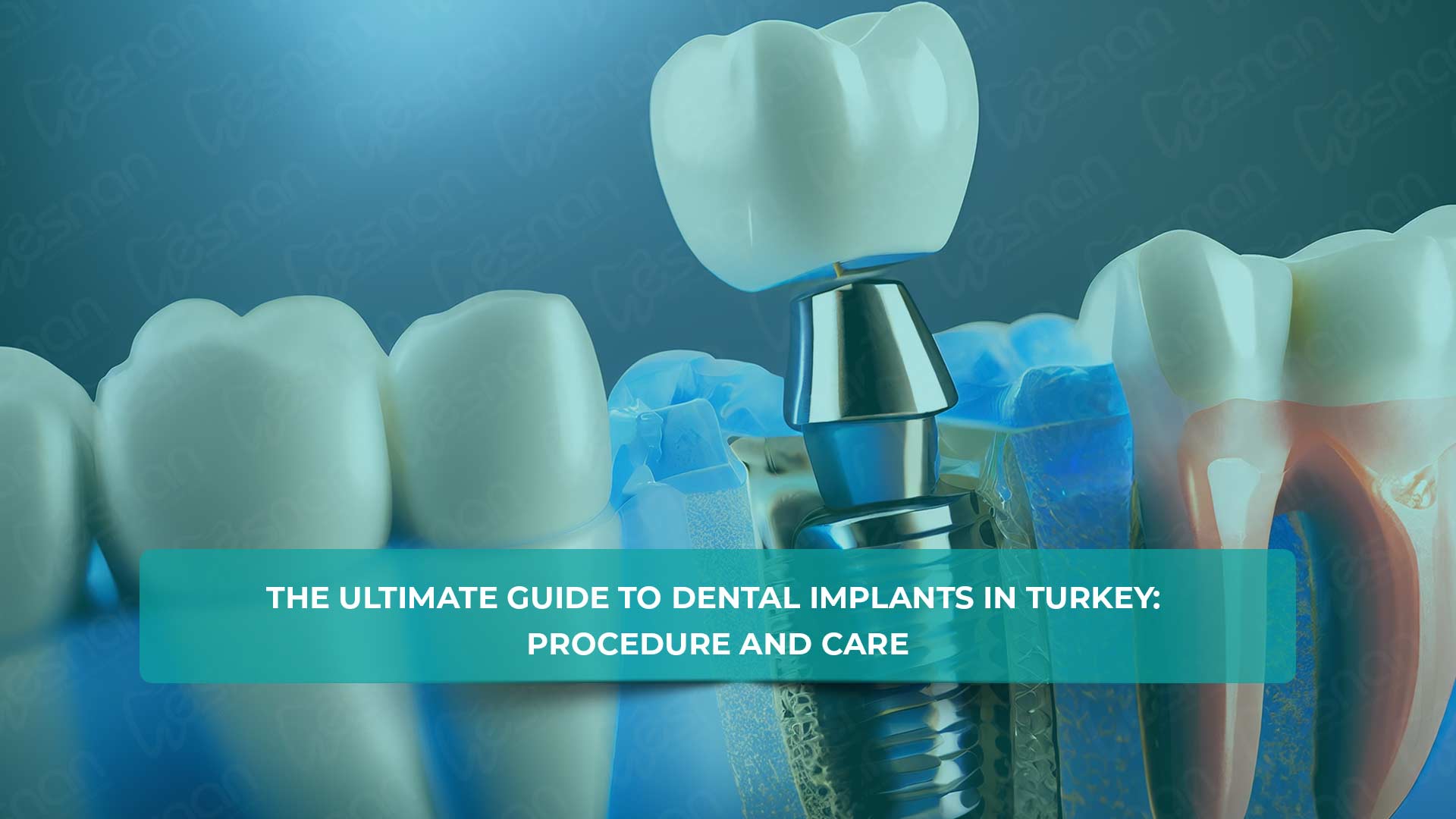 The Ultimate Guide to Dental Implants in Turkey: Procedure and Care