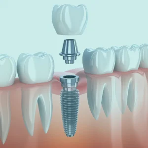 Benefits of Dental Implants in Turkey