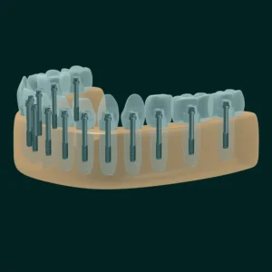 3D imaging in dental implants