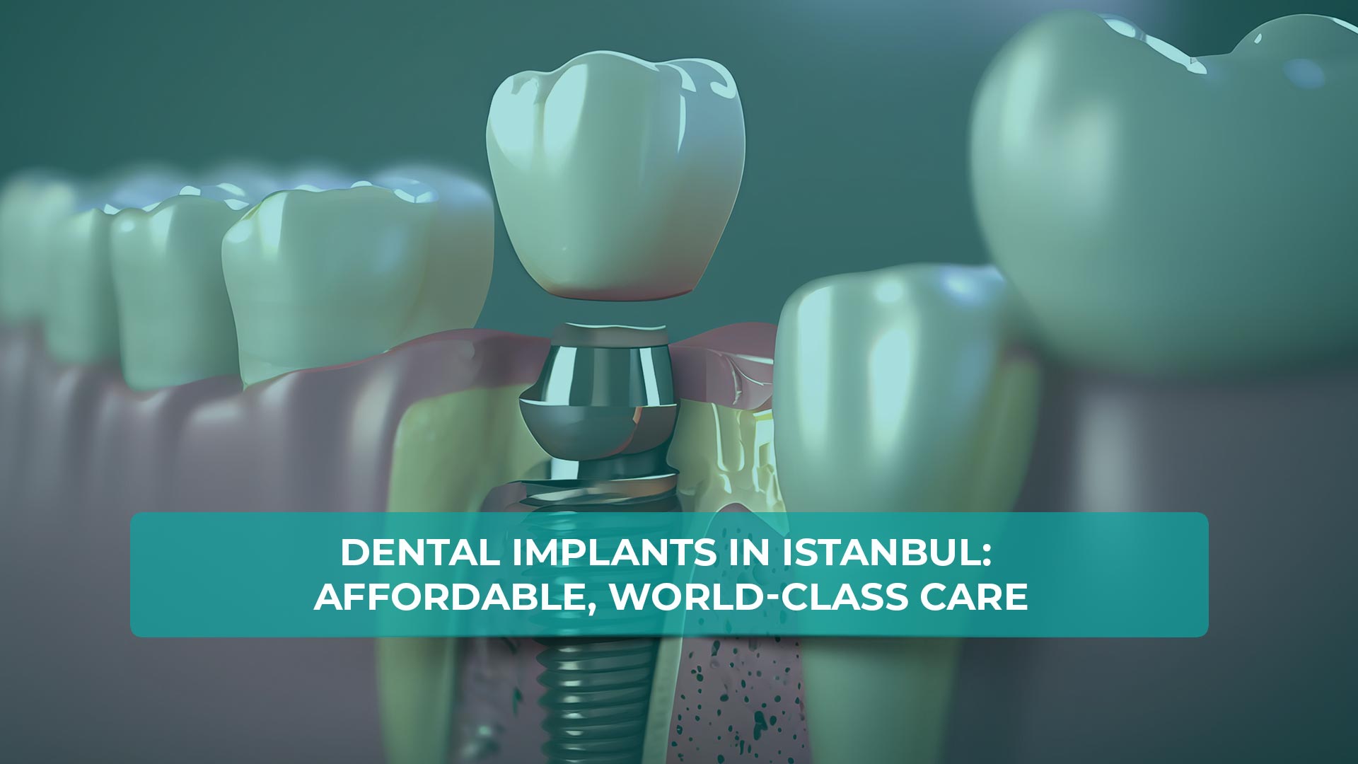 Dental implants in Istanbul, offering affordable and world-class care.