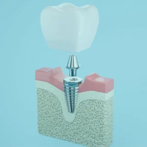 Dental implants in Istanbul: Considerations and preparation