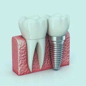 Dental implants cost and financing options in Turkey