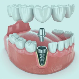 Understanding dental implants in Istanbul, Turkey